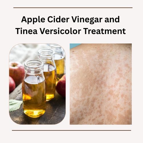 Apple Cider Vinegar and Tinea Versicolor Treatment: What You Need to Know