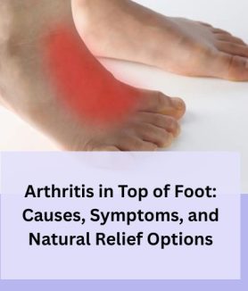 Arthritis in Top of Foot