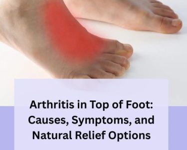 Arthritis in Top of Foot