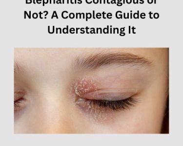 Blepharitis Contagious