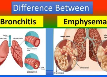 Bronchiectasis vs Emphysema