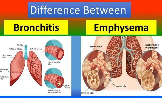 Bronchiectasis vs Emphysema