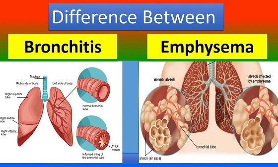 Bronchiectasis vs Emphysema