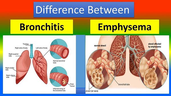 Bronchiectasis vs Emphysema Explained — Which One Damages Your Lungs More?