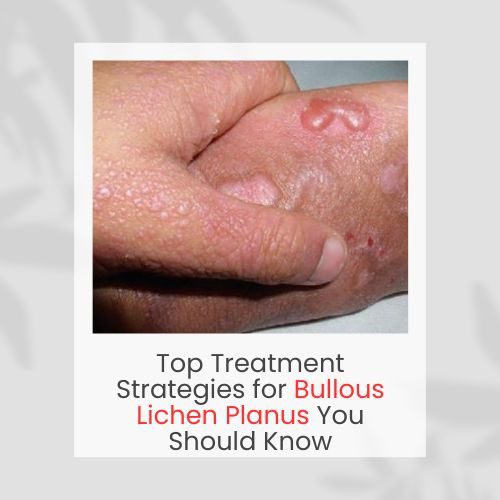 Top Treatment Strategies for Bullous Lichen Planus You Should Know