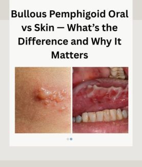 Bullous Pemphigoid Oral