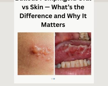 Bullous Pemphigoid Oral