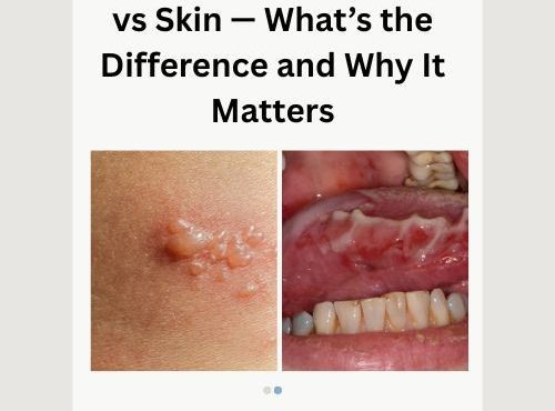 Bullous Pemphigoid Oral