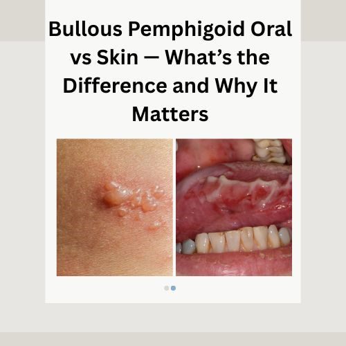 Bullous Pemphigoid Oral vs Skin — What’s the Difference and Why It Matters
