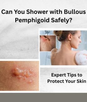 Can You Shower with Bullous Pemphigoid Safely