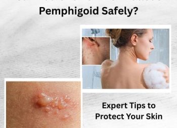 Can You Shower with Bullous Pemphigoid Safely