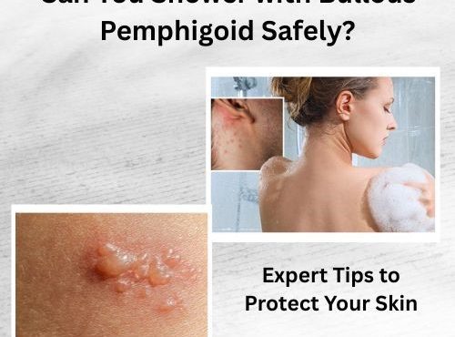 Can You Shower with Bullous Pemphigoid Safely