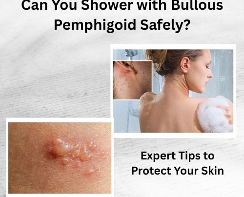 Can You Shower with Bullous Pemphigoid Safely
