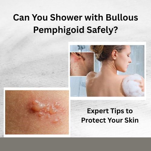 Can You Shower with Bullous Pemphigoid Safely? Expert Tips to Protect Your Skin