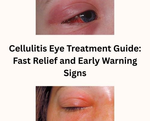 Cellulitis Eye