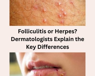 Folliculitis or Herpes