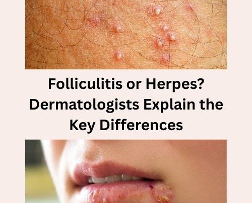 Folliculitis or Herpes
