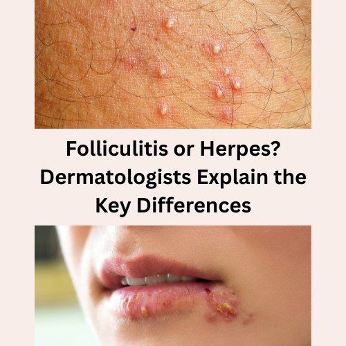 Folliculitis or Herpes? Dermatologists Explain the Key Differences