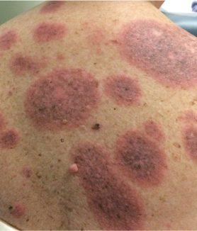 Granuloma Annulare Cancer Risk