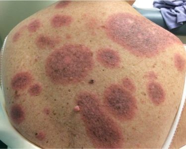 Granuloma Annulare Cancer Risk