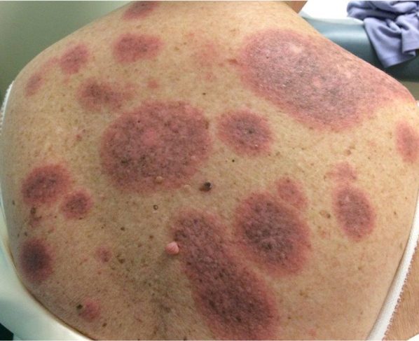 Granuloma Annulare Cancer Risk