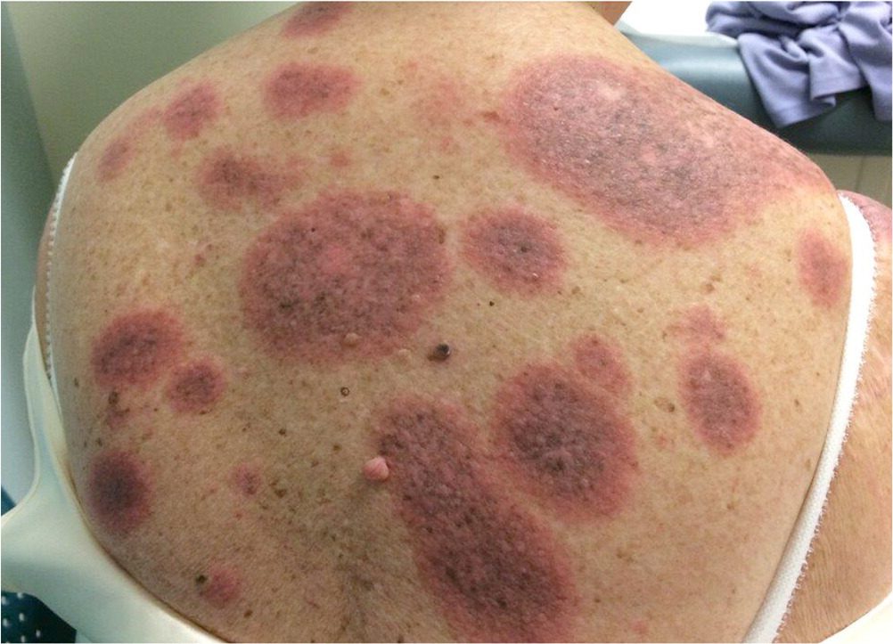 Granuloma Annulare Cancer Risk: The Hidden Link You Must Not Ignore