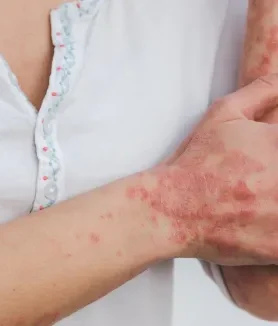 Granuloma Annulare and Stress