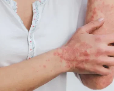 Granuloma Annulare and Stress