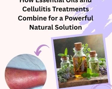 How Essential Oils and Cellulitis Treatments