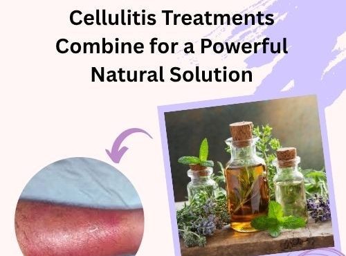 How Essential Oils and Cellulitis Treatments