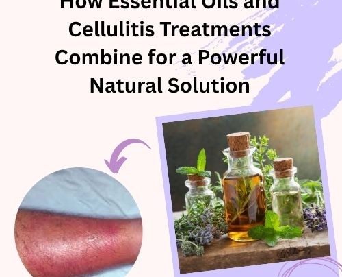 How Essential Oils and Cellulitis Treatments