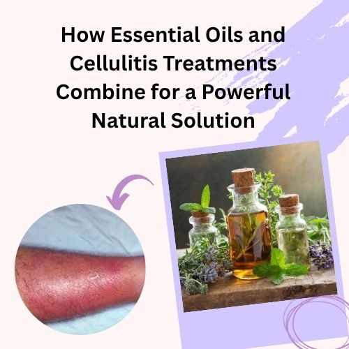 How Essential Oils and Cellulitis Treatments Combine for a Powerful Natural Solution