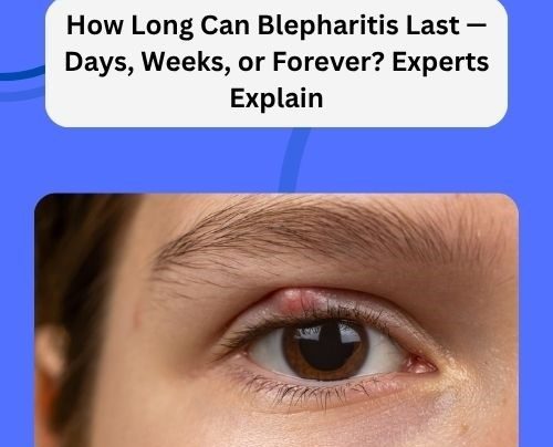 How Long Can Blepharitis Last