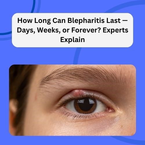 How Long Can Blepharitis Last — Days, Weeks, or Forever? Experts Explain