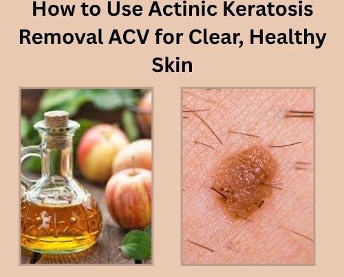 actinic keratosis removal acv​