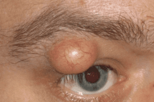 Sebaceous Cyst Eyelid Treatment Plan