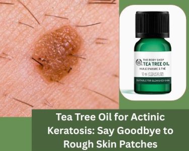 Tea Tree Oil for Actinic Keratosis