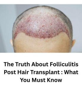Folliculitis Post Hair Transplant
