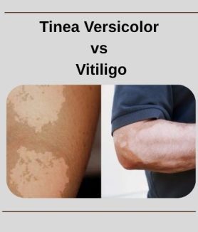 Tinea Versicolor vs Vitiligo