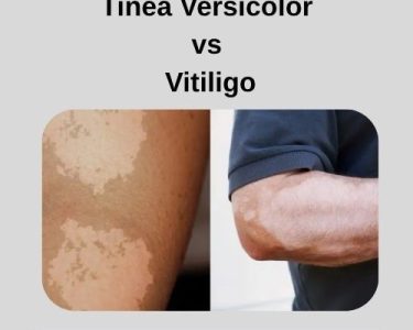 Tinea Versicolor vs Vitiligo