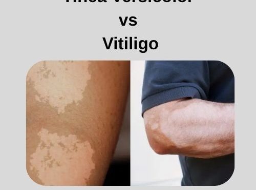 Tinea Versicolor vs Vitiligo