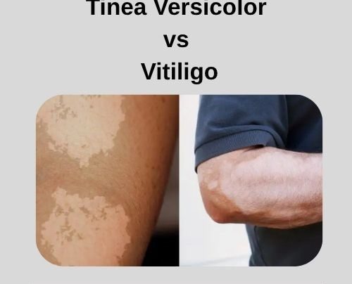 Tinea Versicolor vs Vitiligo