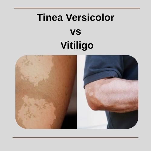 Tinea Versicolor vs Vitiligo: How to Identify and Treat Each Condition