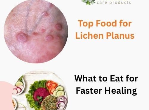 Top Food for Lichen Planus