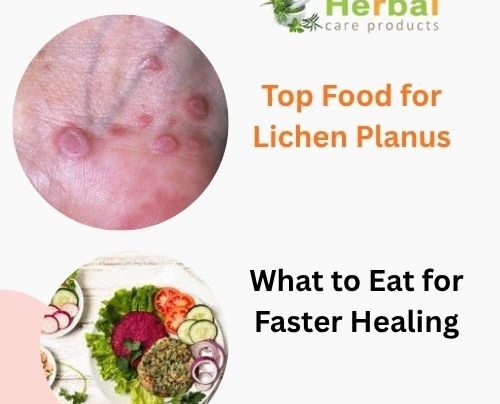 Top Food for Lichen Planus