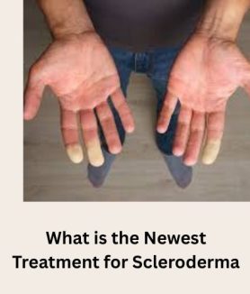 what is the newest treatment for scleroderma​