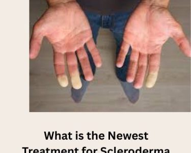 what is the newest treatment for scleroderma​