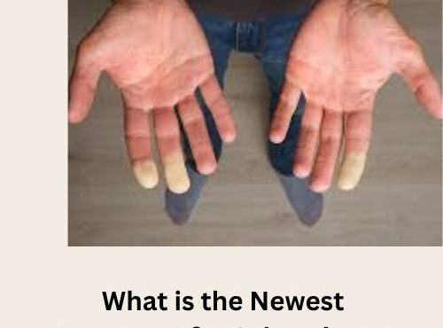 what is the newest treatment for scleroderma​