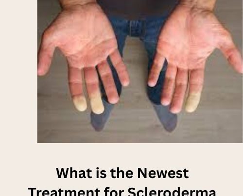 what is the newest treatment for scleroderma​