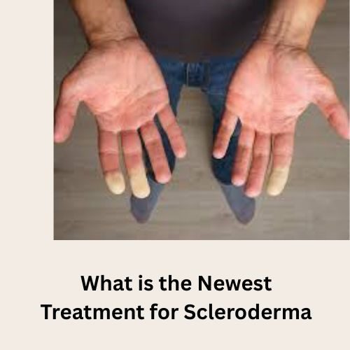 What Is the Newest Treatment for Scleroderma? Exploring Modern Advances and Natural Remedies for Scleroderma